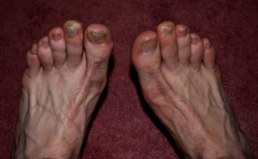 Ноги пораженные грибковой инфекцией