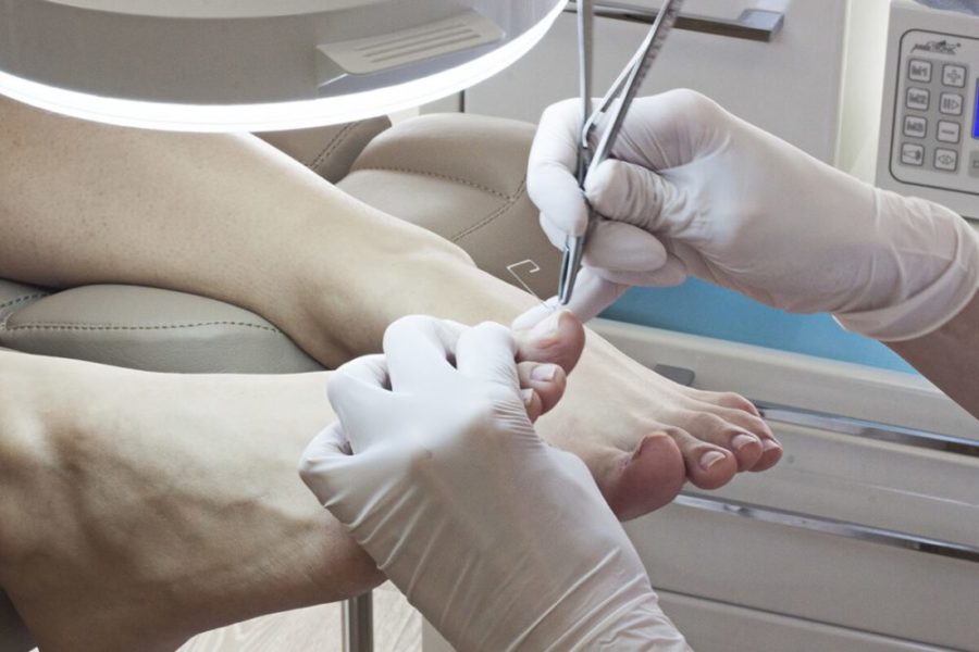 Процедура удаления ногтя на ноге