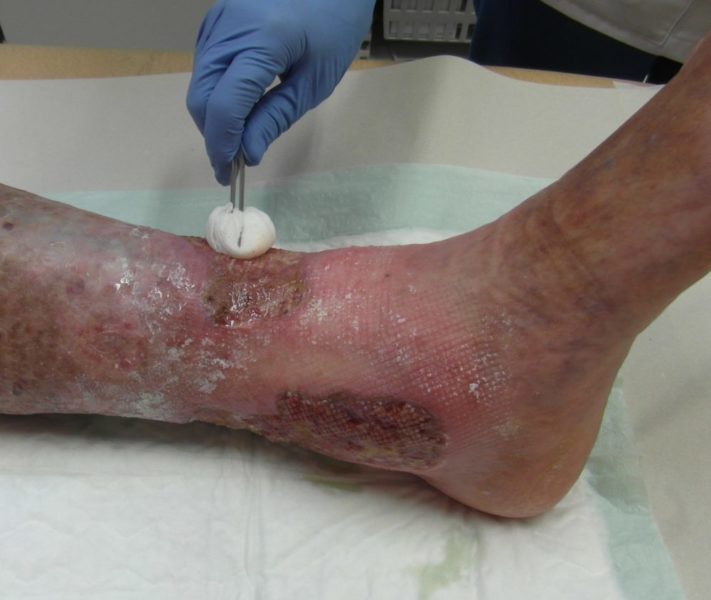 Лечение гонгрены на ноге