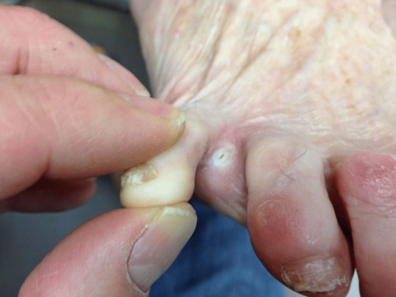Пораженные грибком пальцы ноги