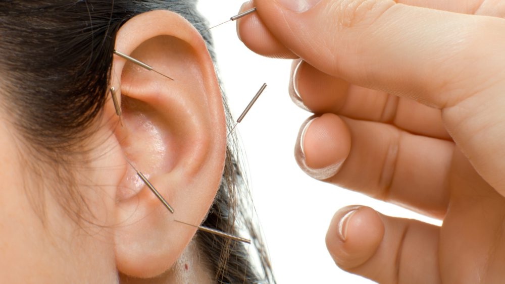Иглоукалывание в области уха