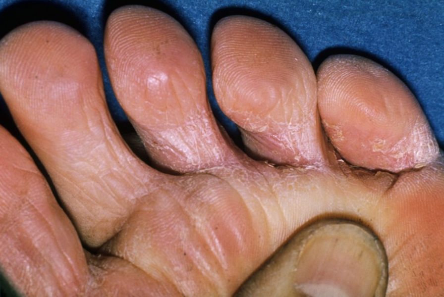Шелушение кожи на пальцах ноги
