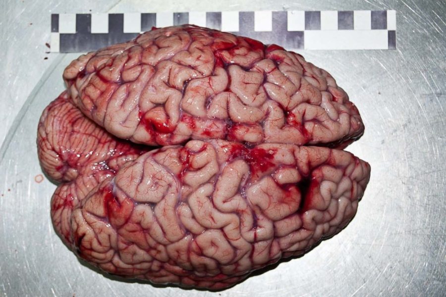 Эмболия сосудов головного мозга