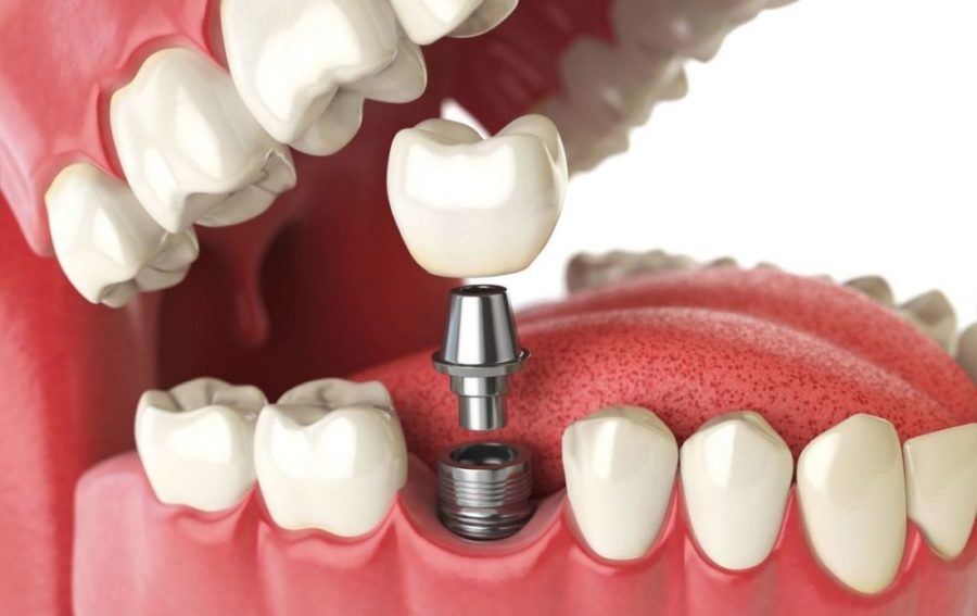 Металлический имплант для зуба