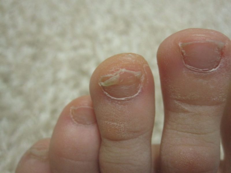 Зараженные грибком ногти
