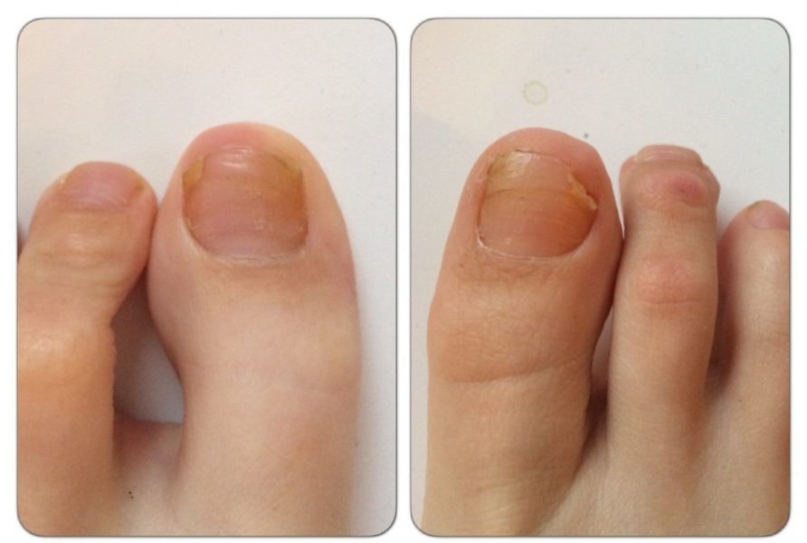 Грибковые ногти до и после применения крема