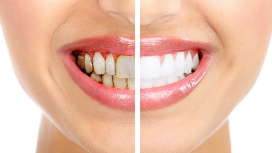 Зубы до и после отказа от курения