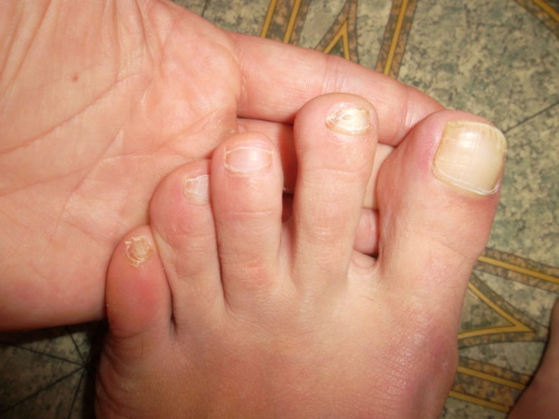 Больные ногти на ногах