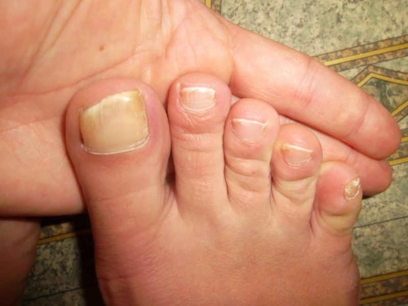 Псориаз на ногтях ноги