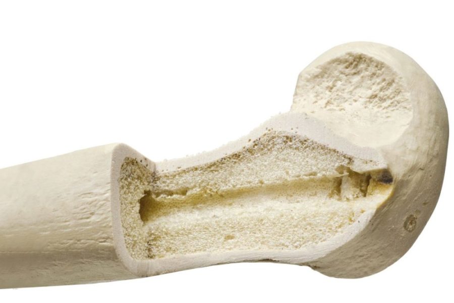 Хрупкая кость