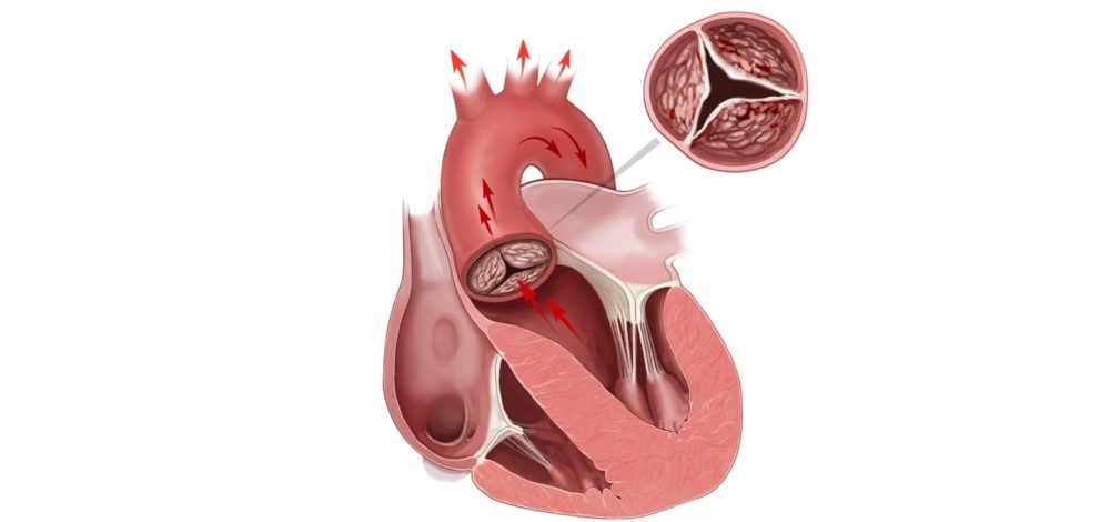 Атеросклероз аорты сердца
